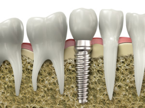 Benefits of Dental Implants